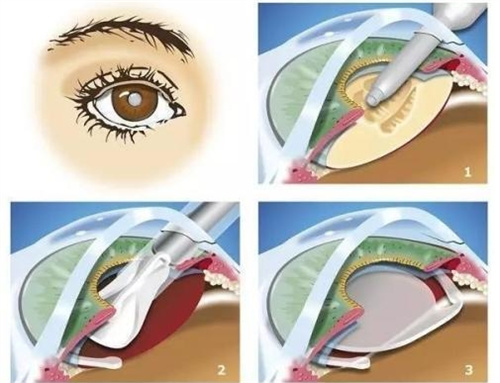 全飞秒手术流程图