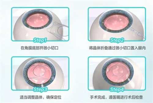 icl晶体植入怎么做